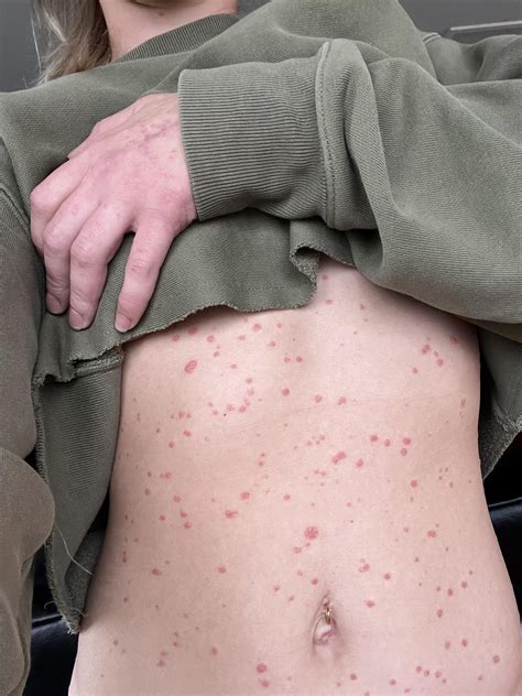 Skin Infections + Psoriasis : r/Psoriasis