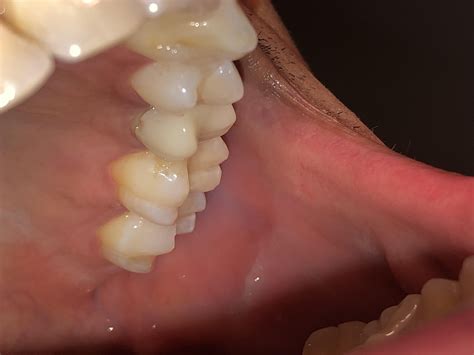 Sensitivity and foul odor for crown at gumline, is it done for? : r