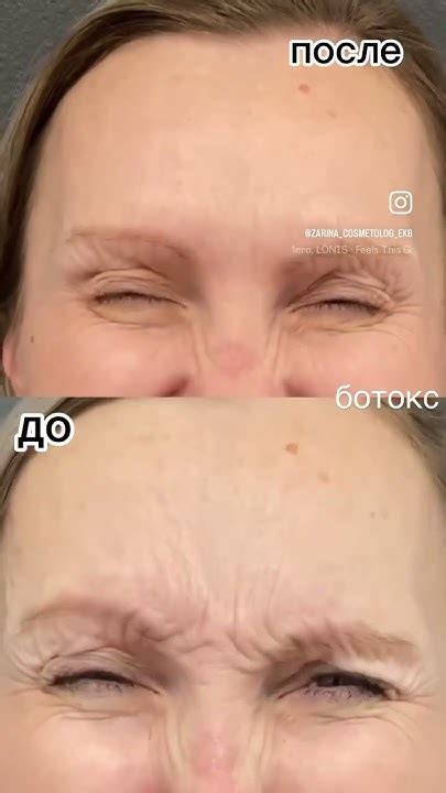 Ботокс до и после Морщины - YouTube