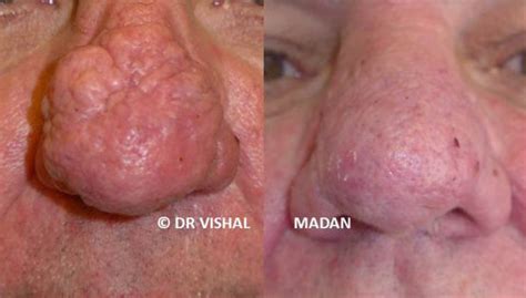 Rhinophyma Laser – UK-Dermatologist