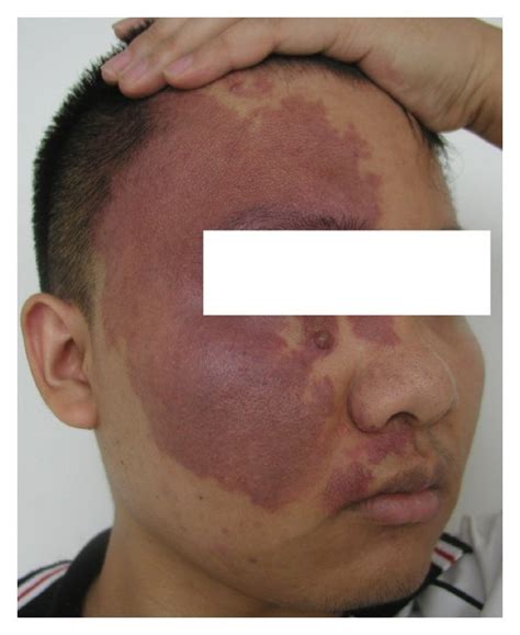 PWS symptom. (a) PWS in face. (b) PWS in neck. (c) PWS in arm and hand ...