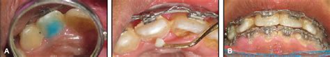 Gradual Grinding of a Talon Cusp During Orthodontic Treatment - JCO Online - Journal of Clinical ...