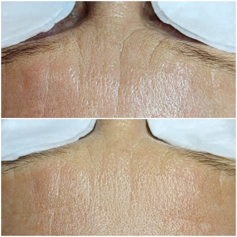 Microneedling - Skin Deep Med Spa