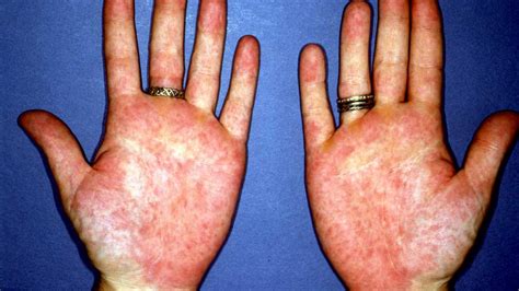 Palmar erythema: Causes, symptoms, and treatment