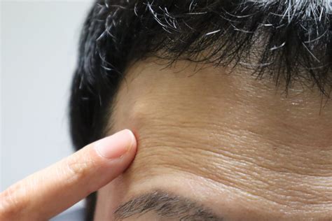 Minor Surgeries - NuSQIN Medical Aesthetics