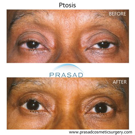 Droopy Eyelid Before And After – UMAU