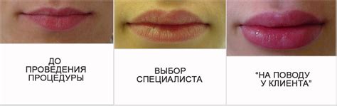Филлеры для губ. Какой филлер лучше для увеличения