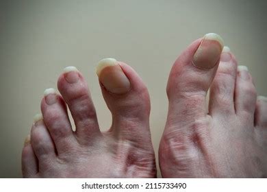 Caucasian Mans Feet Close Long Toenails Stock Photo 2115733490 ...