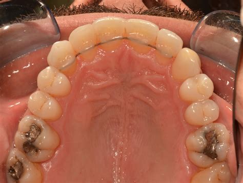 Case Gallery - ClearCorrect