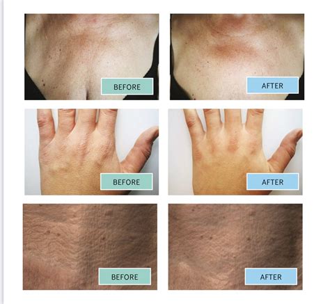 BIOREPEEL 35% TCA Peel — Ink & Hair