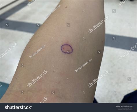 Ppd Tuberculosis Images: Browse 61 Stock Photos & Vectors Free Download ...