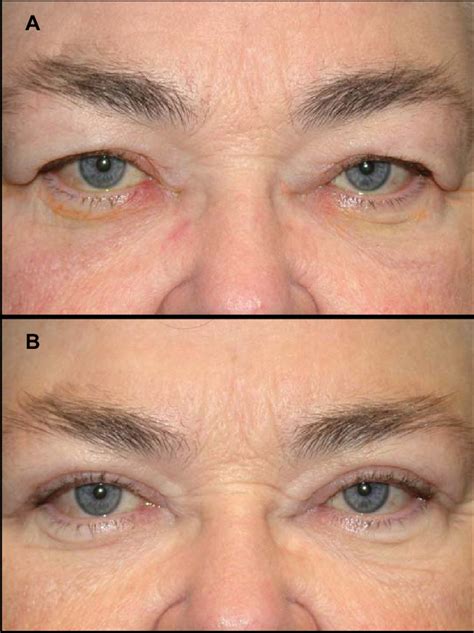 periorbital edema