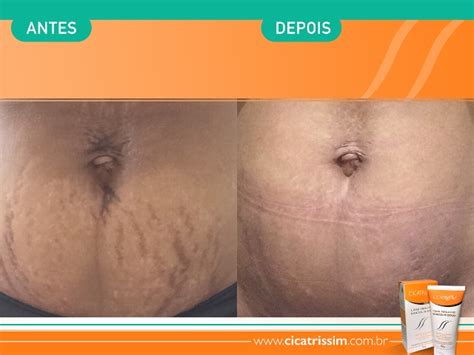 Estrias Vermelhas Como Remover - Estrias Vermelhas Somem – Estrias: o que são, causas, tratamento e como ...