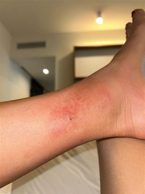 Infected bug bite in Italy. : r/DermatologyQuestions