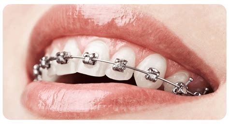 metallic braces elyzee day surgery medical center llc