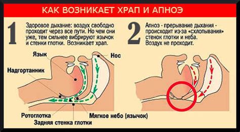 Храп: почему человек храпит, причины, как бороться с храпом, фото и ...