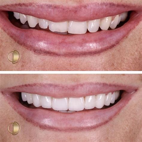 Виниры E.MAX в Москве - цены на услуги DentalOpera