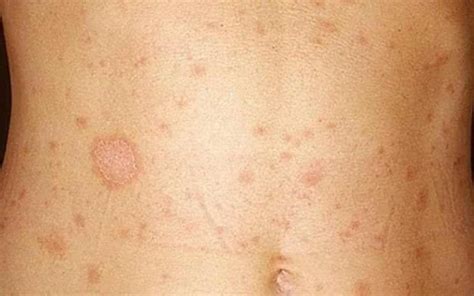 Висівкоподібний лишай (різнокольоровий лишай) | HealthApple