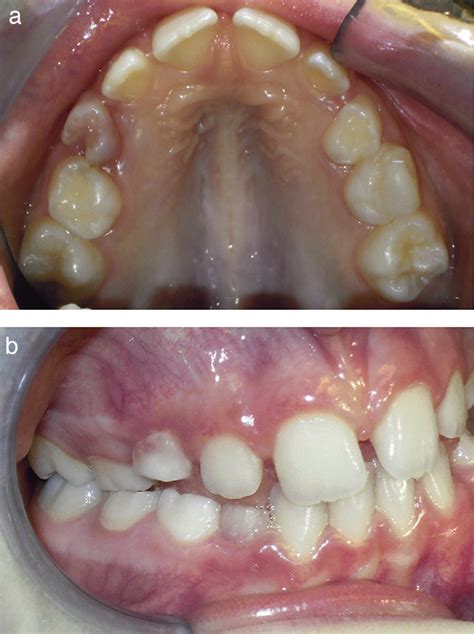 pre treatment photographs  mesial shift   maxillary