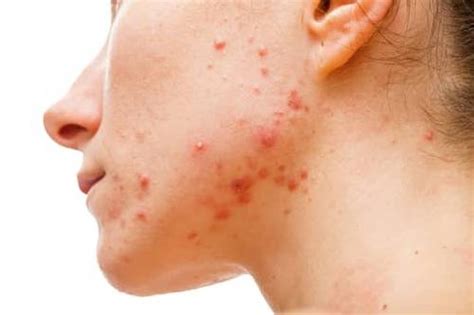 The Causes Of Zits And How To Treat It - PELIONCHESS
