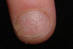 Симптом наперстка (Thimble sign)