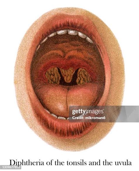 928 Diphtheria Stock Photos, High-Res Pictures, and Images - Getty Images