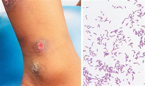 difteri   perlu diketahui  kata dokter