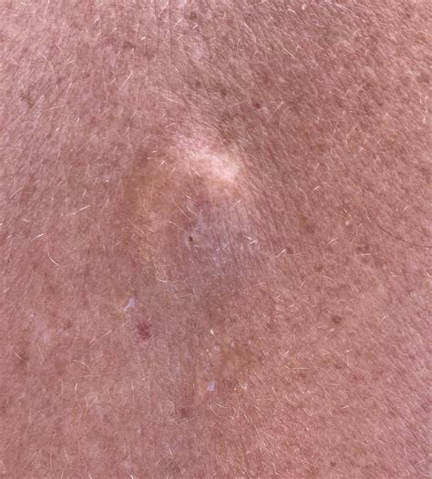Hard lump on spine : r/DermatologyQuestions