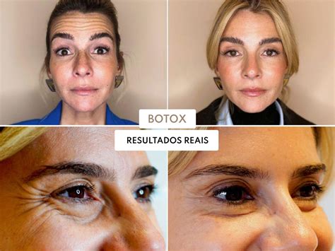 Exossomas Antes E Depois - Exossomas: Tratamento inovador para a pele do rosto - Skin Boutique
