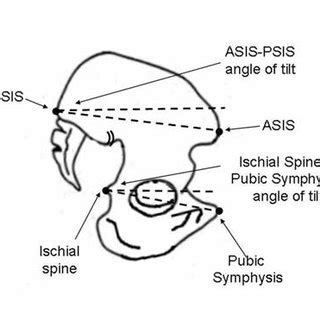 Schematic diagram of the pelvis illustrating the ASIS-PSIS measure of ...