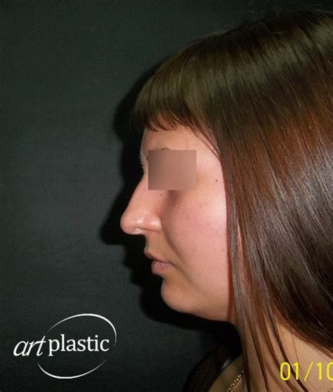 Ринопластика / Фото / Альбом №111 | Клиника Art-Plastic