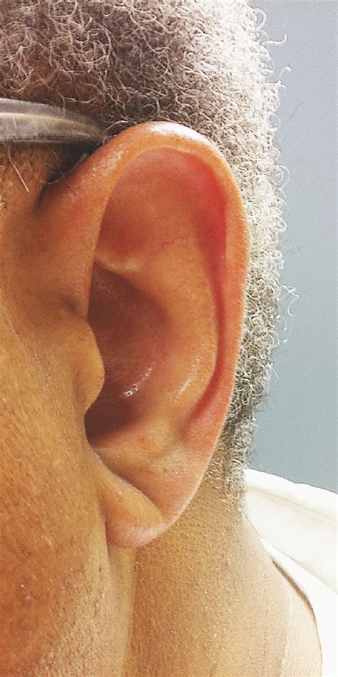 Frank's Sign | New England Journal of Medicine