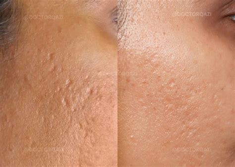 Acne Scars Before and After