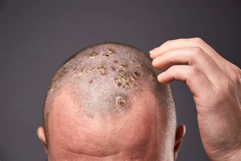seborrheic keratosis  rockville md shady grove dermatology