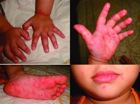 Papules and blisters on the hand, foot and mouth on the third day ...