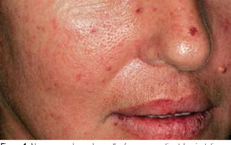 Figure 1 from Oral medicine case book 62: CREST syndrome. | Semantic ...