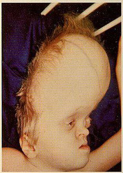 Hydrocephaly - MEDizzy
