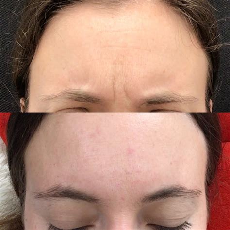 Before & After | Aria Medical Aesthetics | Southington, CT
