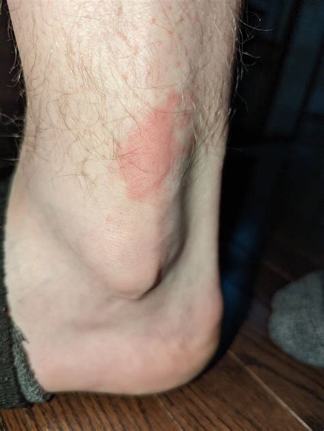 Intermittent rash and weird/numb feeling skin : r/medical