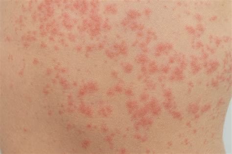 hivesurticaria archives dr kent woo