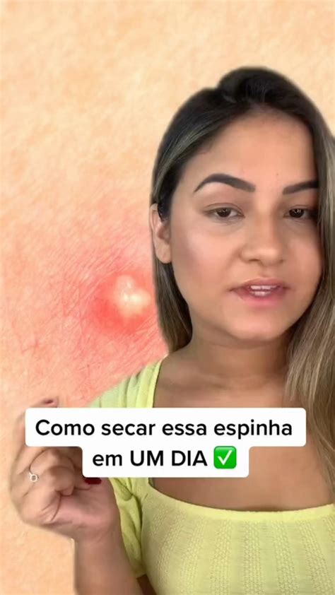 Como Tirar As Espinhas Em Um Dia