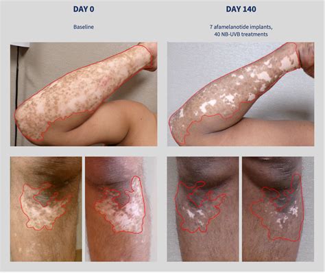 CLINUVEL recruits 200 patients in Phase III vitiligo trial