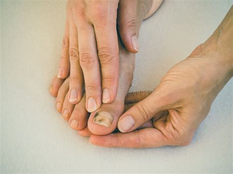 Bruise on the Nail, Close-up. Painful Bruising on Her Toenails. Stock ...