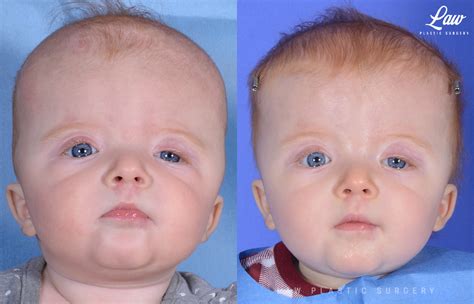 Craniosynostosis Before & After Photos - Sage Plastic Surgery