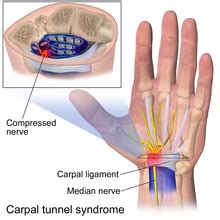 Flexor retinaculum of the hand - Wikipedia