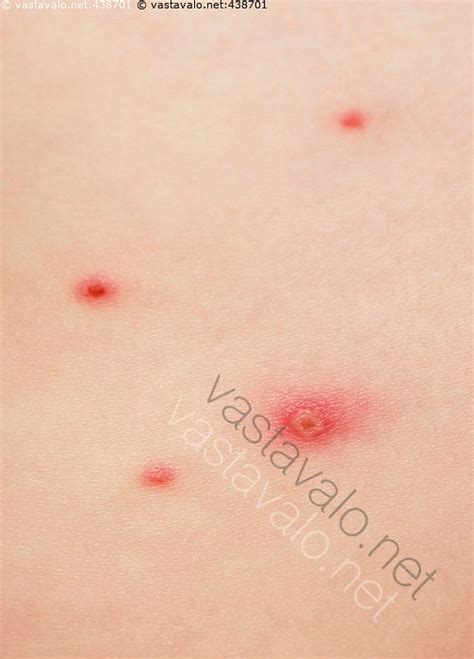 Kuva: Vesirokko - vesirokko virus Varicella zoster sairaus iho näppylä ...