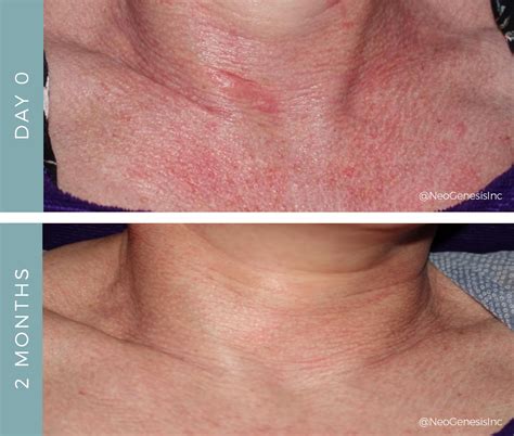 acne rosacea  chest