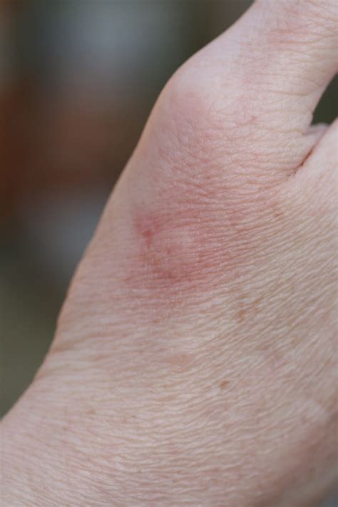 What Do Stings Look Like at Tami Lumley blog
