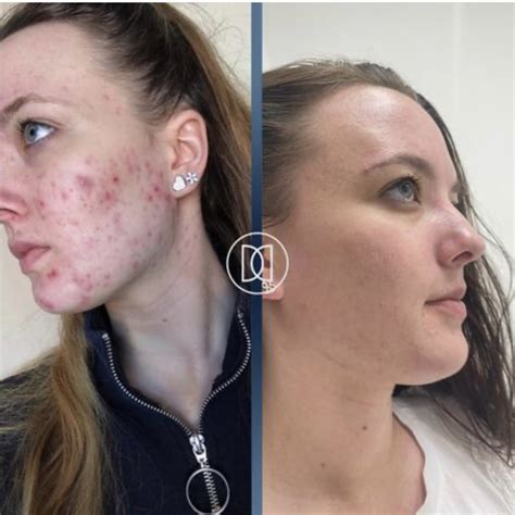 iPixel Laser - DD Clinical