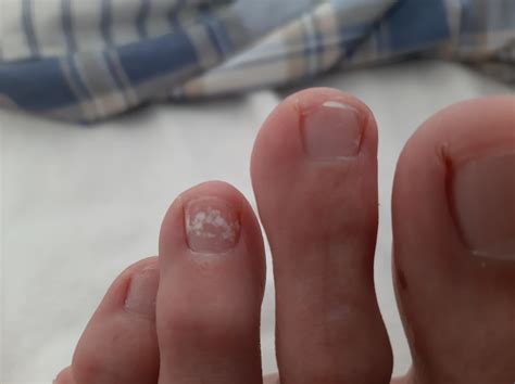 Any idea what this is on my toe nail : r/medical